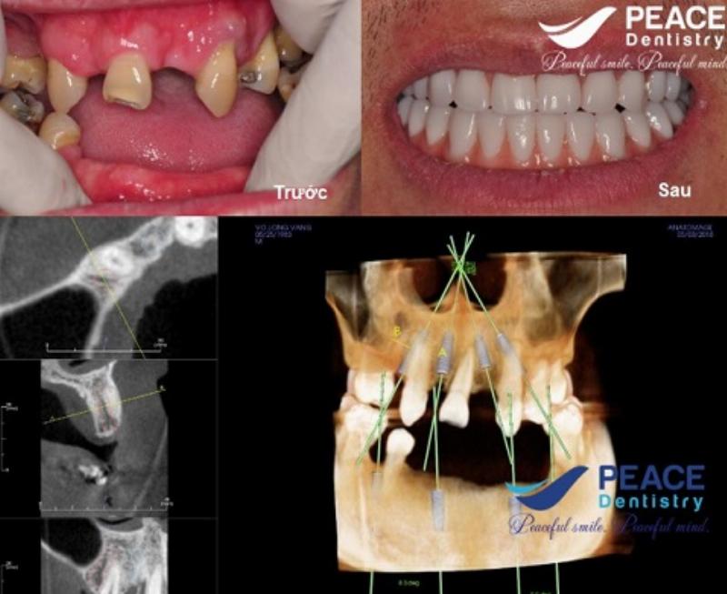 "Mô tả ảnh: Hình ảnh minh họa cho phương pháp trồng răng All-on-4 Implant." width=