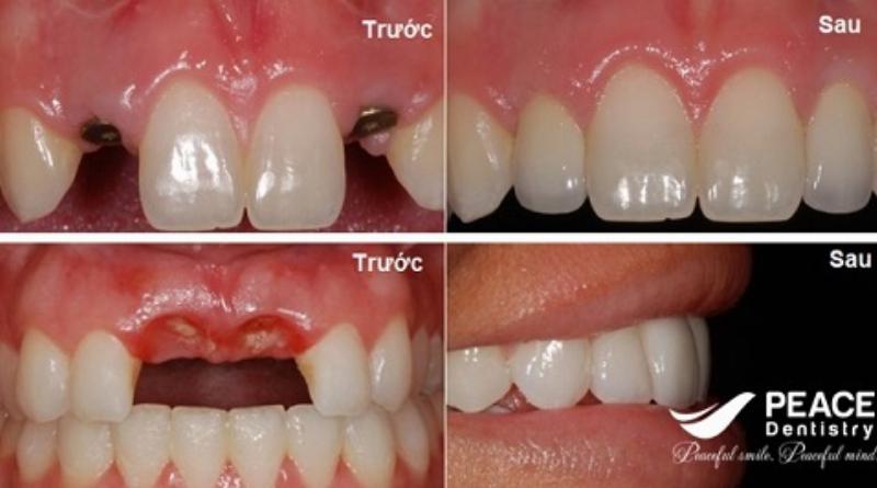 Trồng Răng Giả Cố Định: 3 Phương Pháp Ưu Việt Cho Nụ Cười Tự Tin