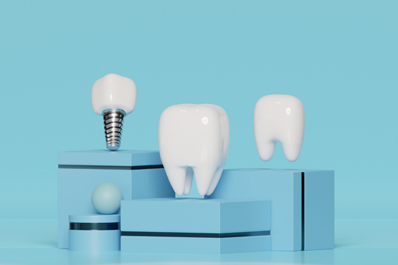 Quy trình trồng răng Implant 4 bước: Khám, cấy ghép trụ, gắn Abutment, lắp mão sứ.